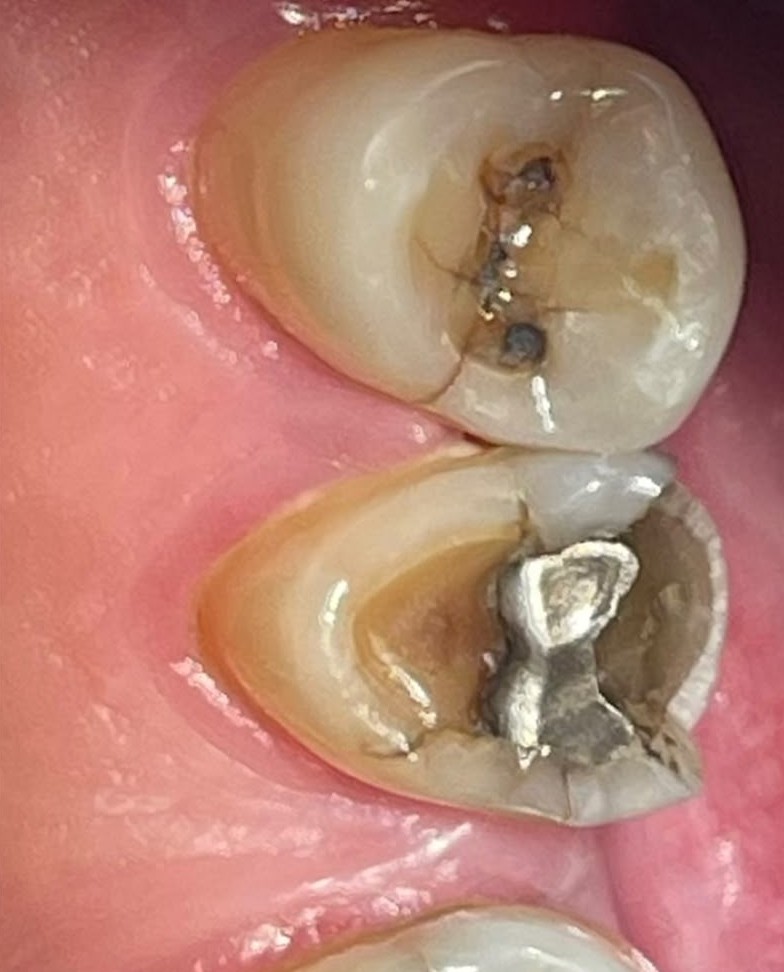 Foto intraoral de dente com restauração de amálgama fraturada atendido pelo Dr. Ricardo Pina no Itaim Bibi