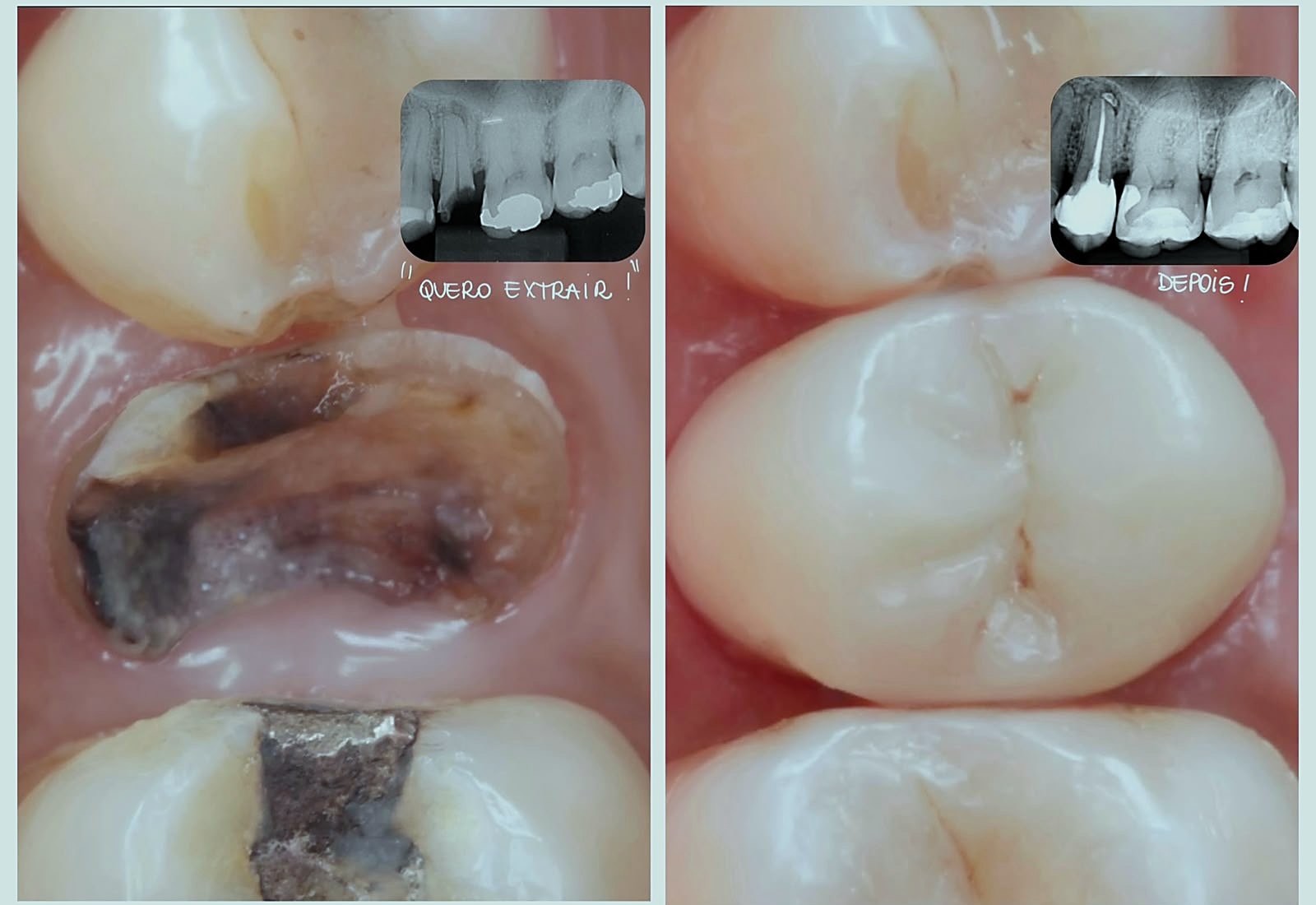 Antes e depois de tratamento de canal em molar com reconstrução, com radiografias comparativas