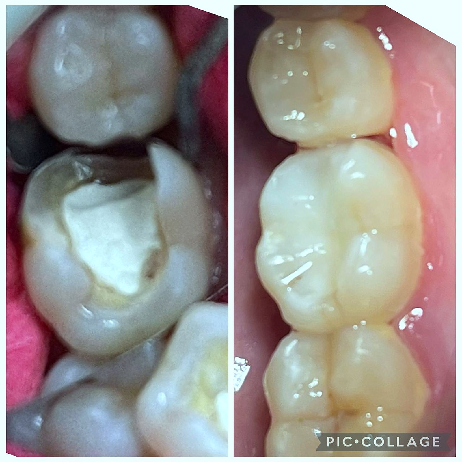 Antes e depois da troca de restauração antiga infiltrada por resina estética