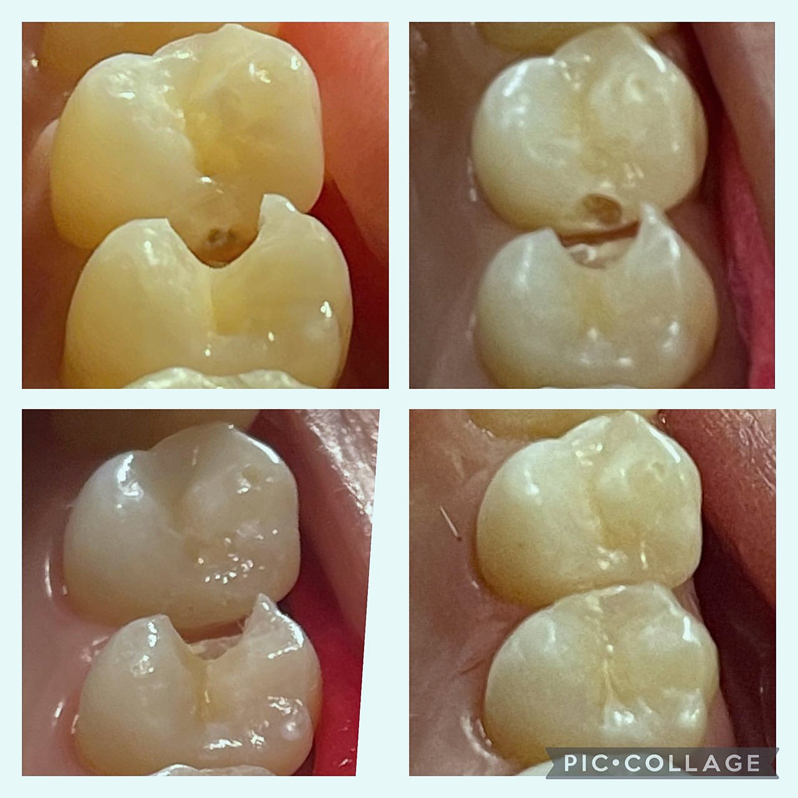 Antes e depois de restaurações em resina em molares