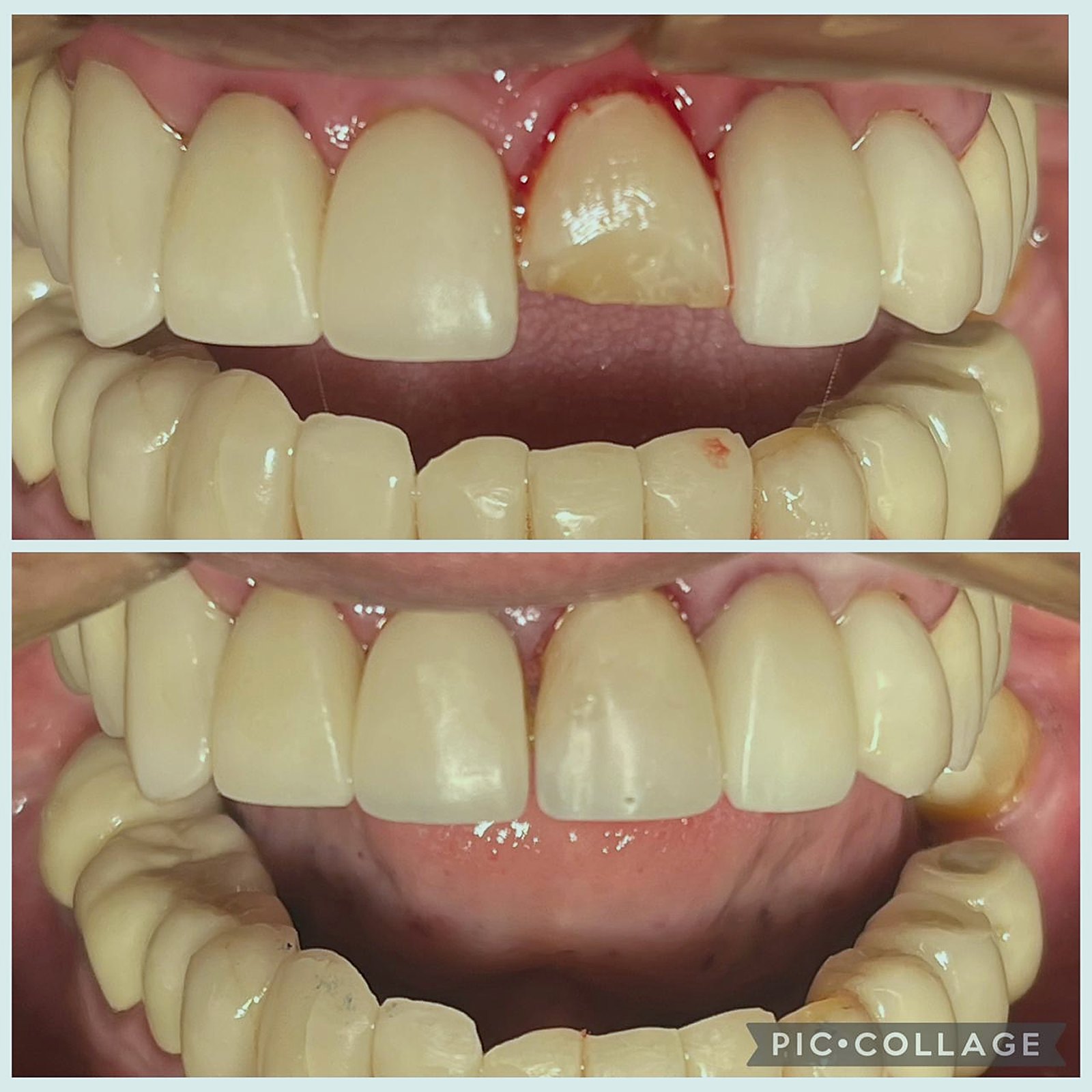 Antes e depois da reconstrução em resina de dente anterior fraturado com gengiva inflamada