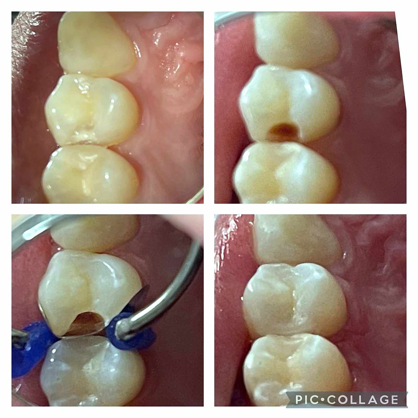 Antes e depois de restauração de cárie interproximal com resina composta