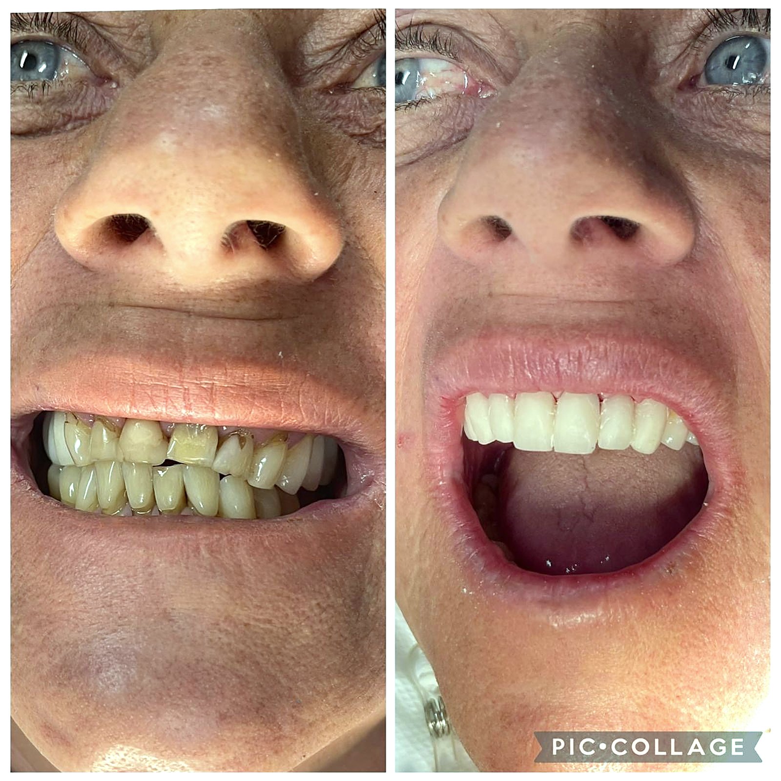 Antes e depois de reabilitação estética completa do sorriso com dentes desgastados restaurados