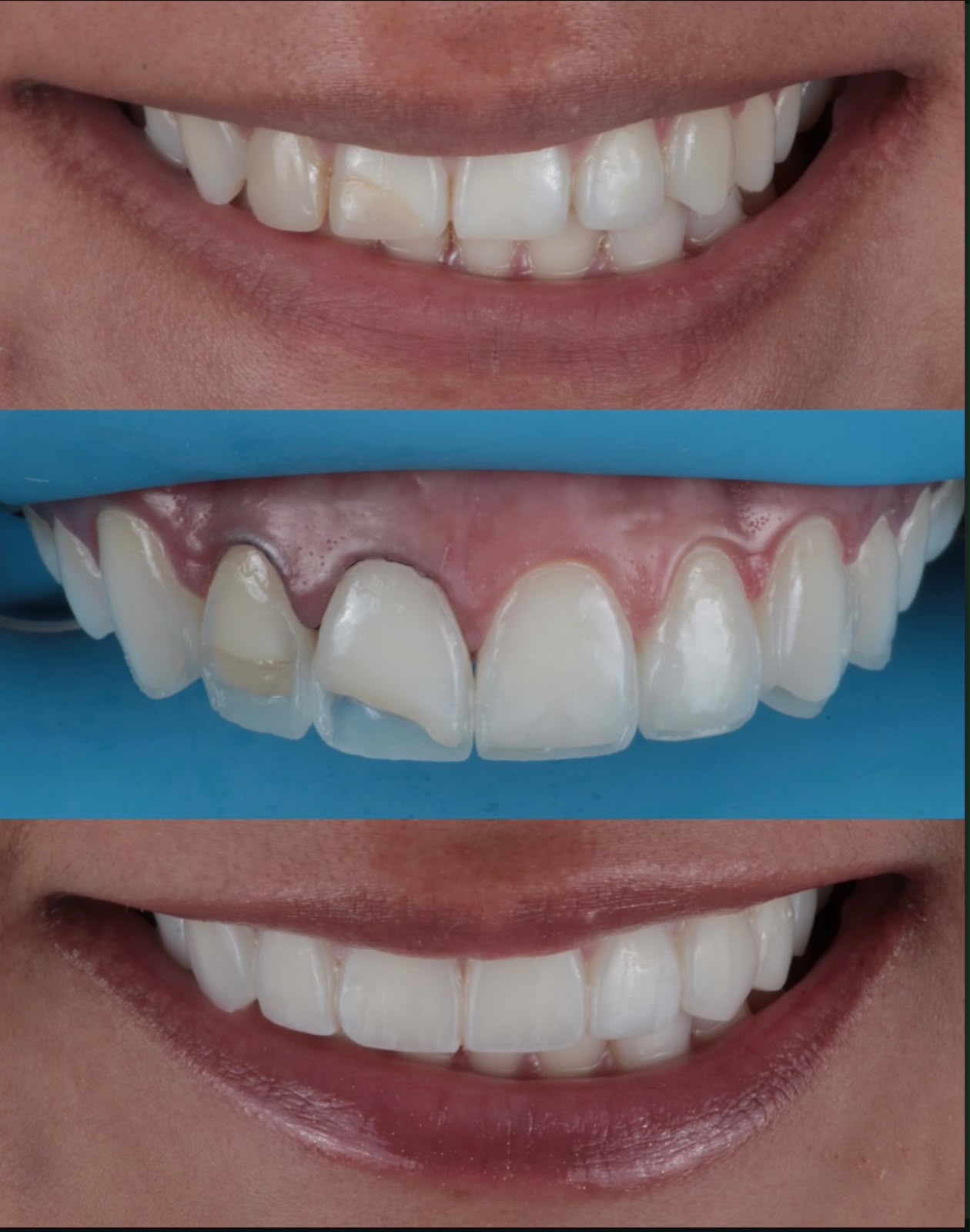 Antes, preparo e depois de reabilitação estética com facetas de porcelana nos dentes anteriores